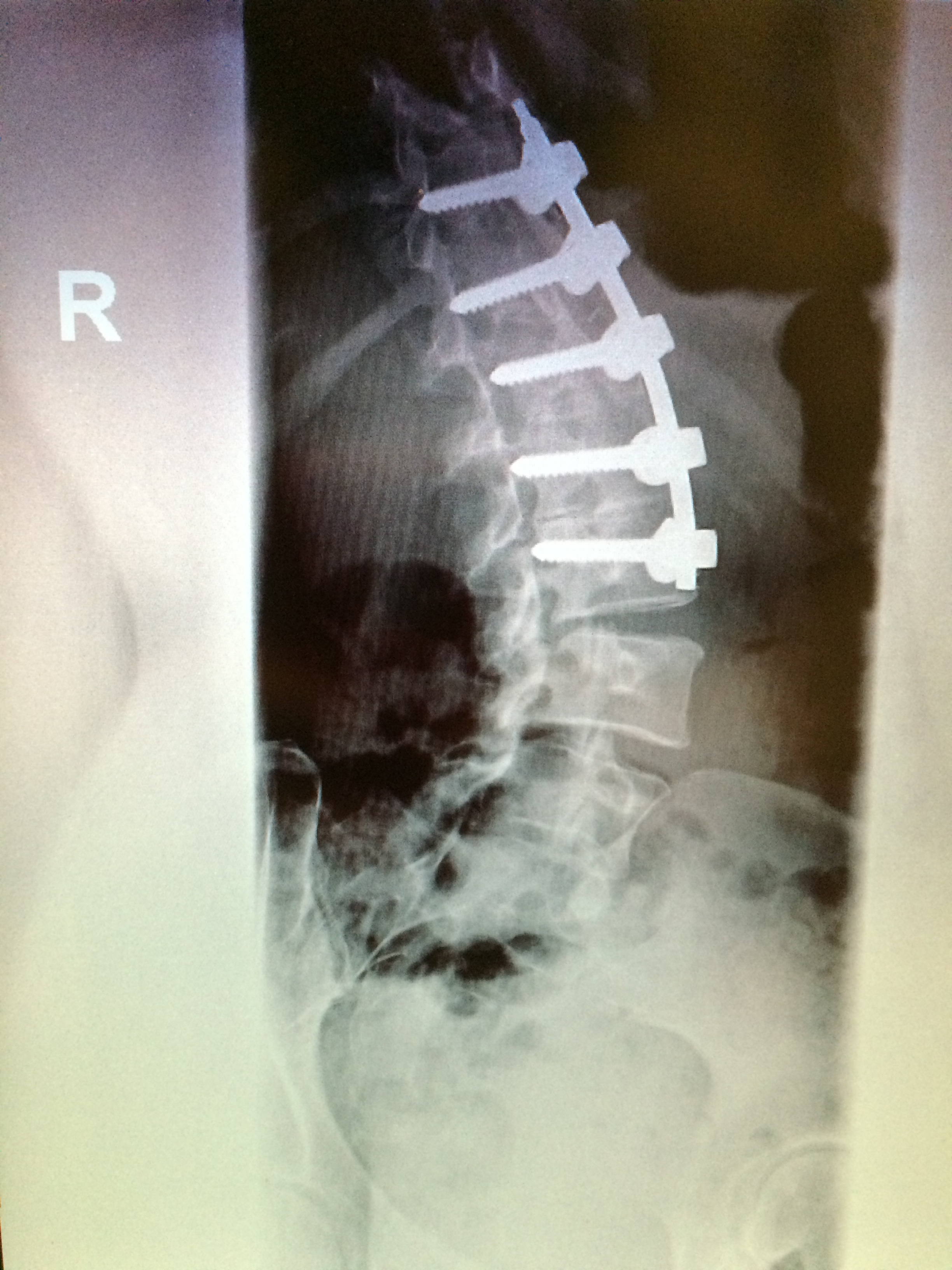 X-ray of the lumbar region of my spine, 2015